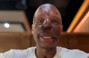 Randy Adams, who posts inspirational content on social media, underwent facial reconstruction in 2025 (Image via Instagram/@ran_riseup)